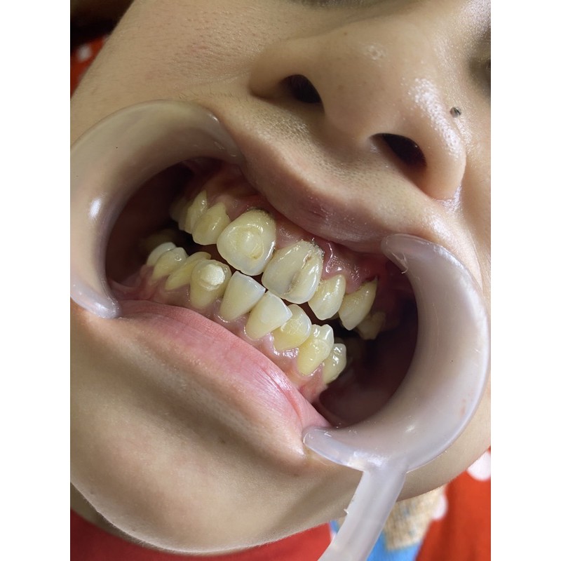 veneer gigi