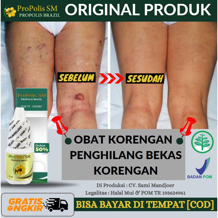 Salep Korengan, Penghilang Kulit Hitam Bekas Korengan, Korengan Hilang Tanpa Bekas, Asli Propolis SM