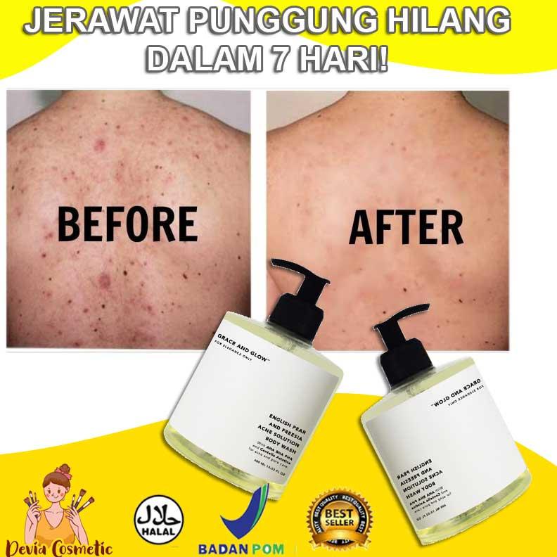 Pop Obat Jerawat Di Punggung Obat Jerawat Punggung Dan Bekasnya Sabun Penghilang Jerawat Punggung Shopee Indonesia