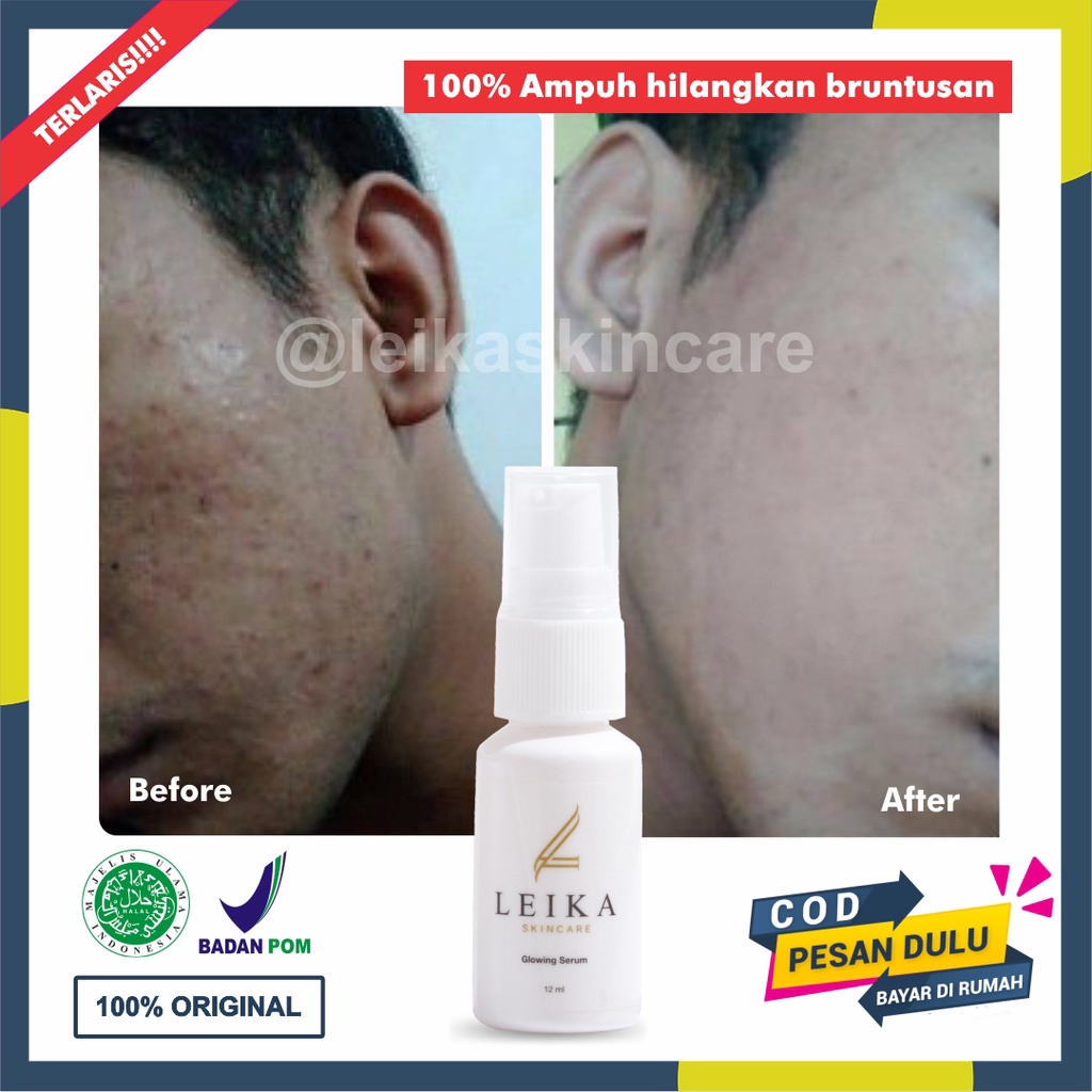 Serum Penghilang Bruntusan Ampuh Permanen BPOM Serum Wajah Bruntusan Pria Serum Untuk Bruntusan Hala
