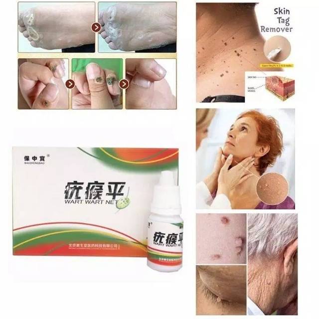 Skin Tag Remover penghilang kutil tahi lalat