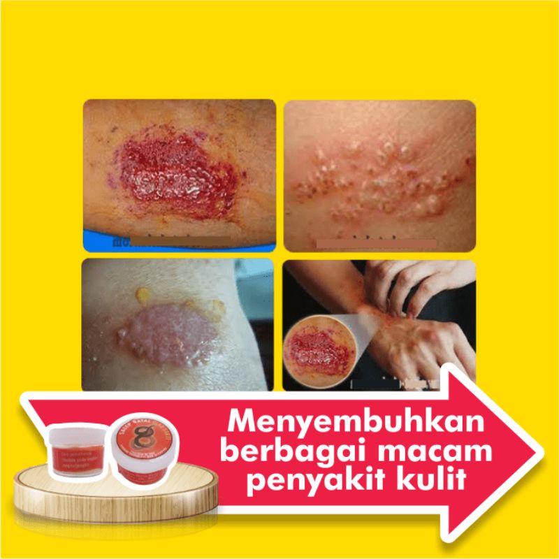 Obat Salep Gatal Eksim Kering Menahun Paling Ampuh Kulit Gatel Basah Selangkangan Kurap Kutu Air Luka Diabetes Panu Kudis Kadas-1