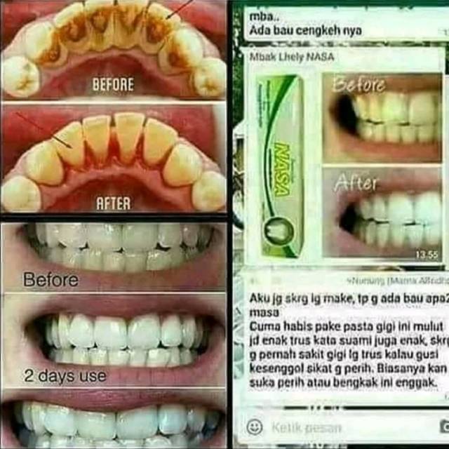 PERONTOK KARANG GIGI