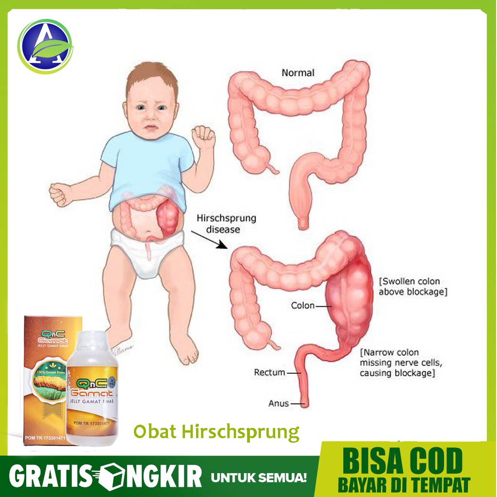 Obat Hirschsprung / Penyakit Hisprung , Sembelit Berkepanjangan Herbal Anak & Dewasa QnC Jelly Gamat