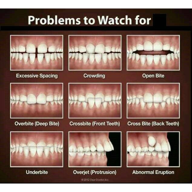 Alat perapi gigi behel merapikan gigi teeth retainer