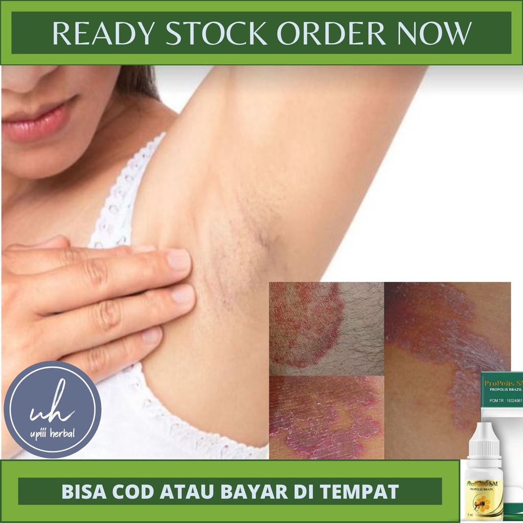 OBAT GATAL DIAREA LIPATAN KETIAK,OBAT OLES ALAMI,OBAT INFEKSI JAMUR DIKETIAK,OBAT JAMUR,KUDIS,KURAP 