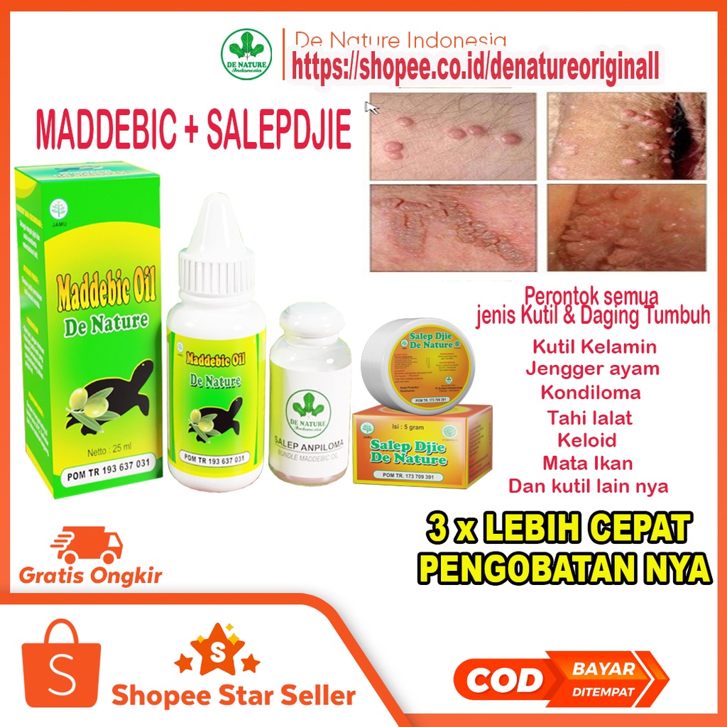 Salep Ampuh Perontok Kutil Kelamin,Jengger Ayam,Tay Lalat,Keloid,Mata Ikan,Kapalan,Kutil Anus Selang