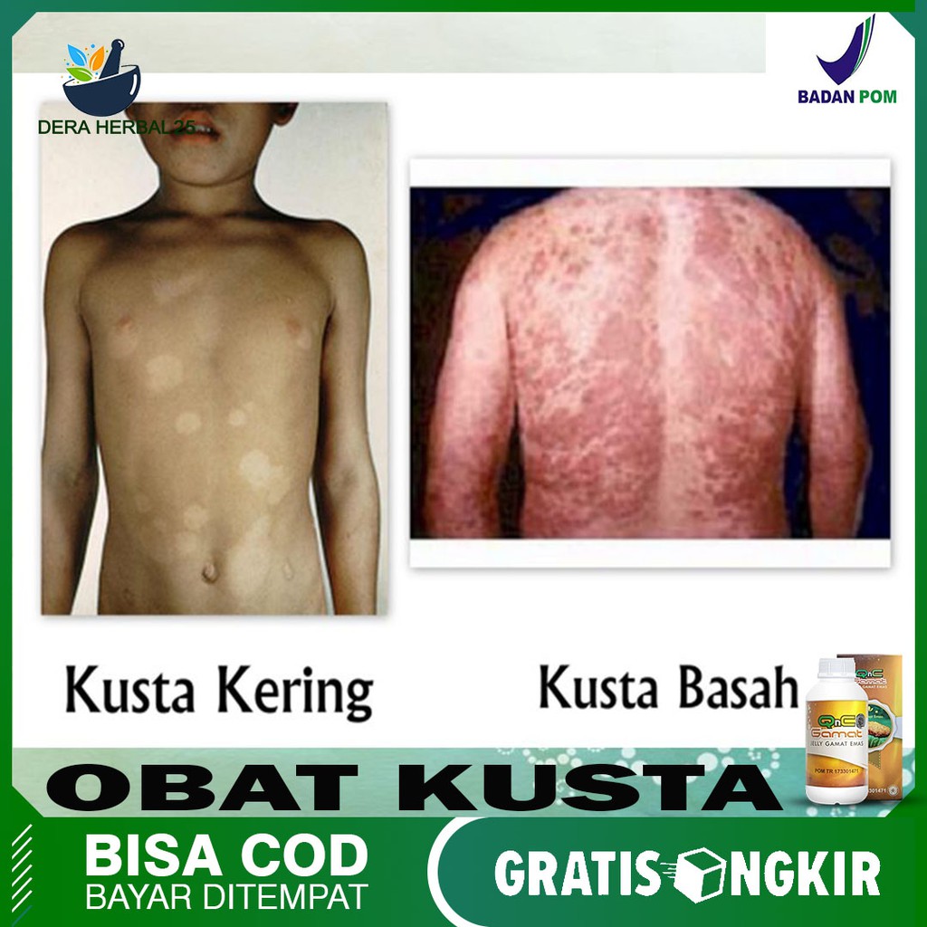 Jual Obat Kusta Lepra Kusta Kering Kusta Basah Obat Penyakit Kulit Qnc Jelly Gamat