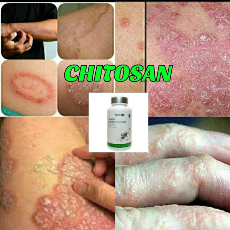 Chitin Chitosan Tiens Atasi penyakit gatal, eksim, exsim, borok, koreng, panu, kurap, kudis bisa COD