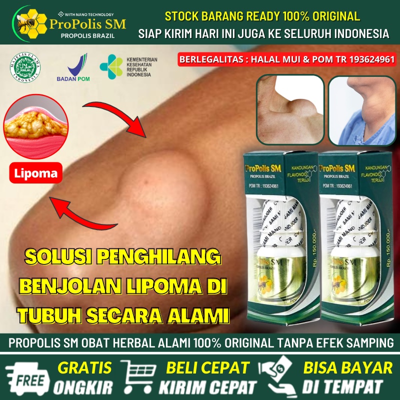 Obat Oles Penghilang Lipoma / Benjolan Lemak di Leher / Tangan / Punggung / Wajah / Telinga - Obat A