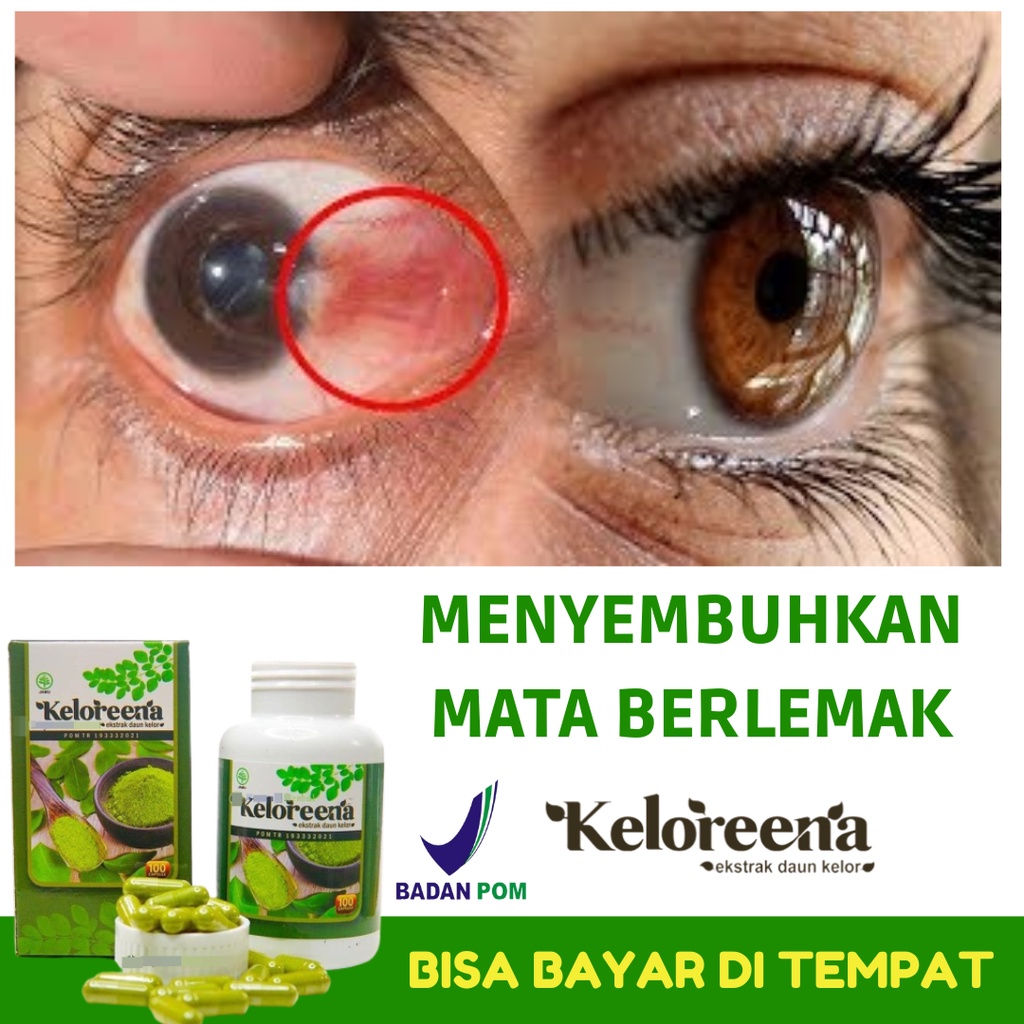 Obat Mata Berlemak Bercak Merah di kelopak mata, Mata Gatal dan Berair, Mata Minus, Mata Rabun Jauh,