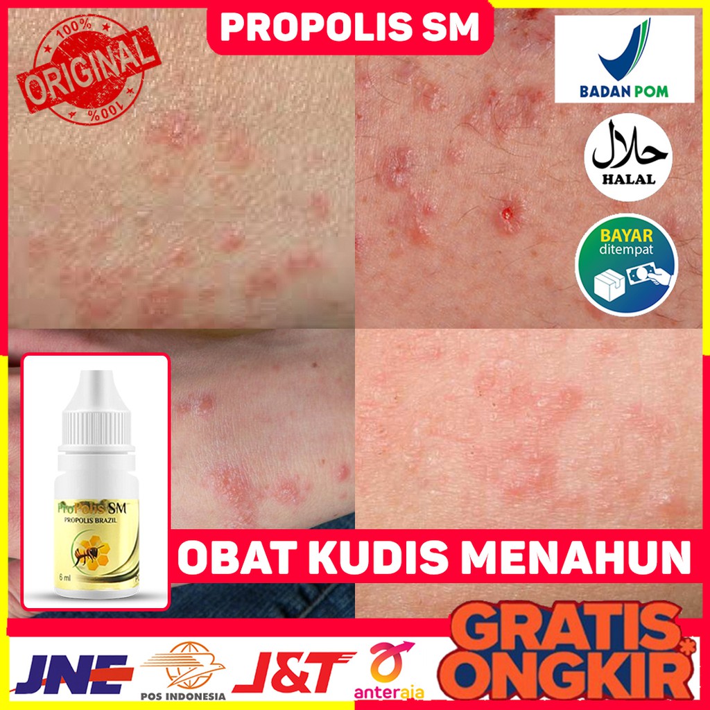 Obat Kudis Menahun, Eksim Kering, Eksim Basah, Panu, Kurap, Kadas, Kudis - Propolis Sm di Solo - COD