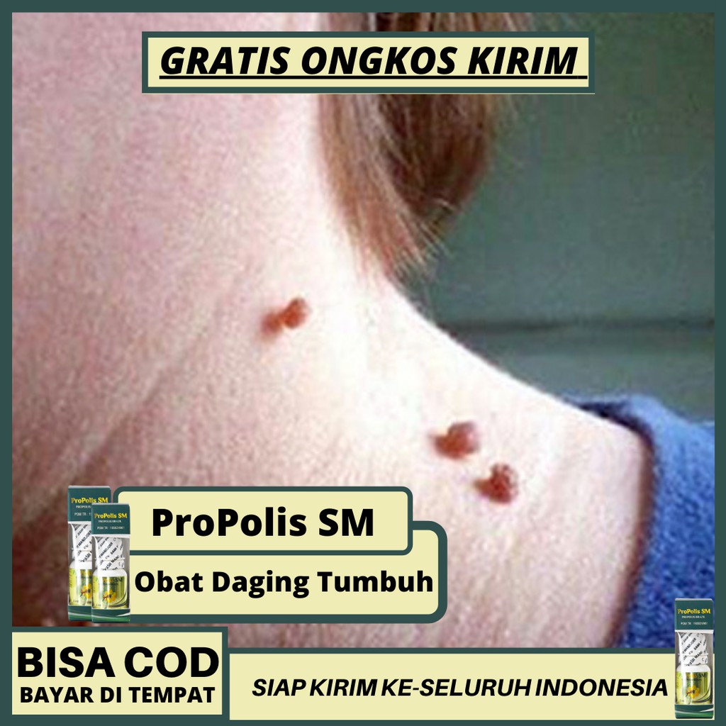 Obat Daging Tumbuh Di Leher Di Pantat Di Ketiak Asli Herbal Propolis Sm Brazil Original Shopee Indonesia