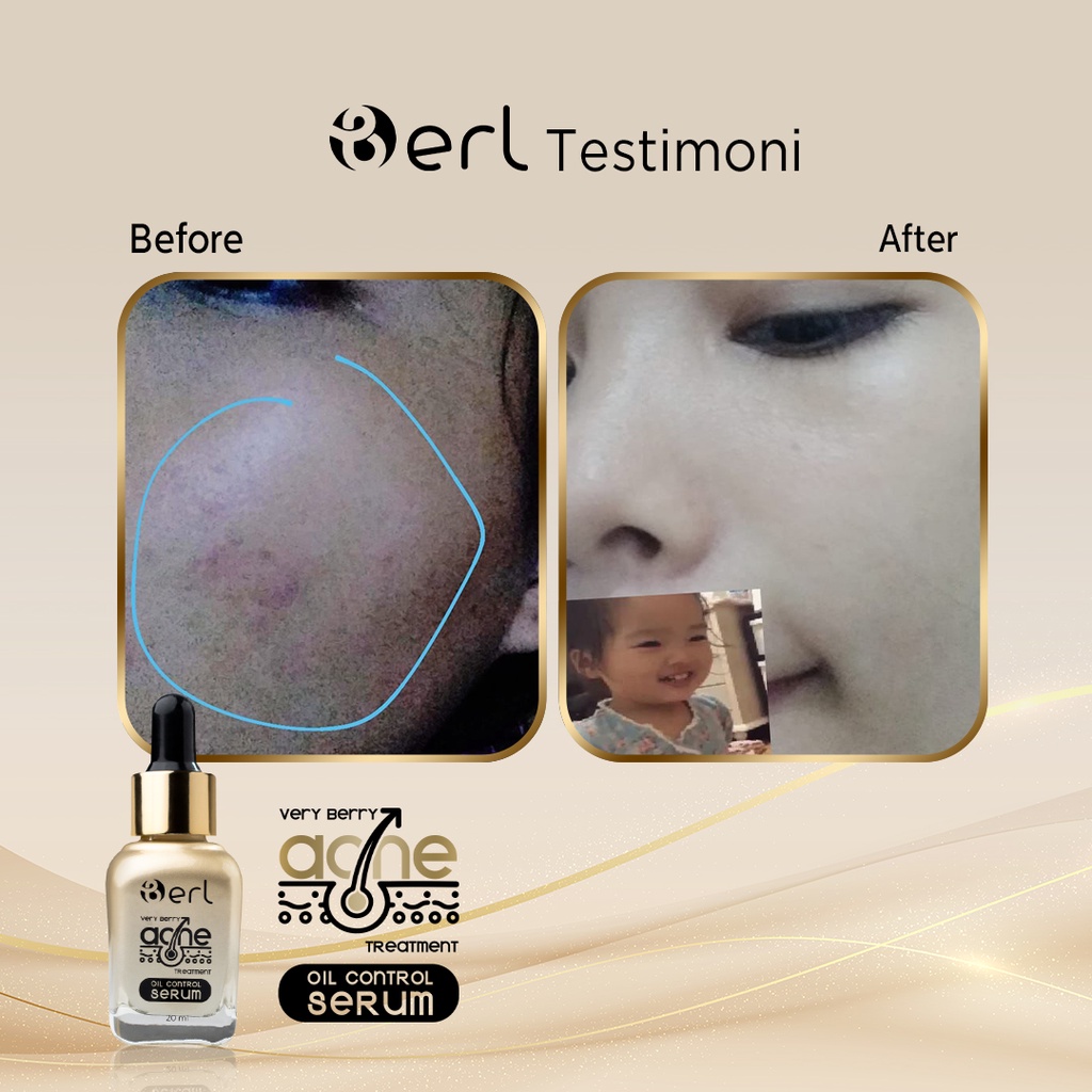 Penghilang Jerawat Acne Serum B ERL Cosmetics | Berl Cosmetics | Berl