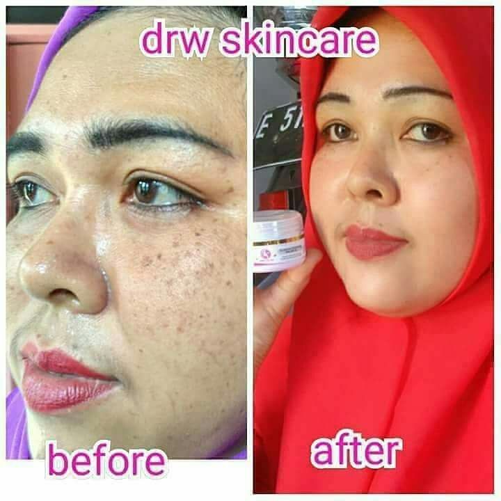 Drw Skincare Paket Flek Hitam Lengkap Komplit Bpom Original 100 Shopee Indonesia
