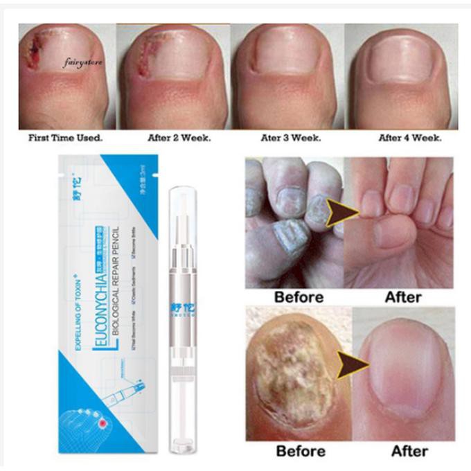 Salep Jamur Kuku Ampuh | Obat Perawatan Jamur Kuku Jari Tangan Kaki