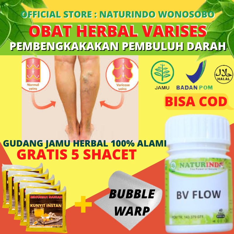 OBAT VARISES MEMULIHKAN KEMBALI PEMBULUH DARAH KAKI HERBAL BV FLOW NATURINDO BISA KEMPES