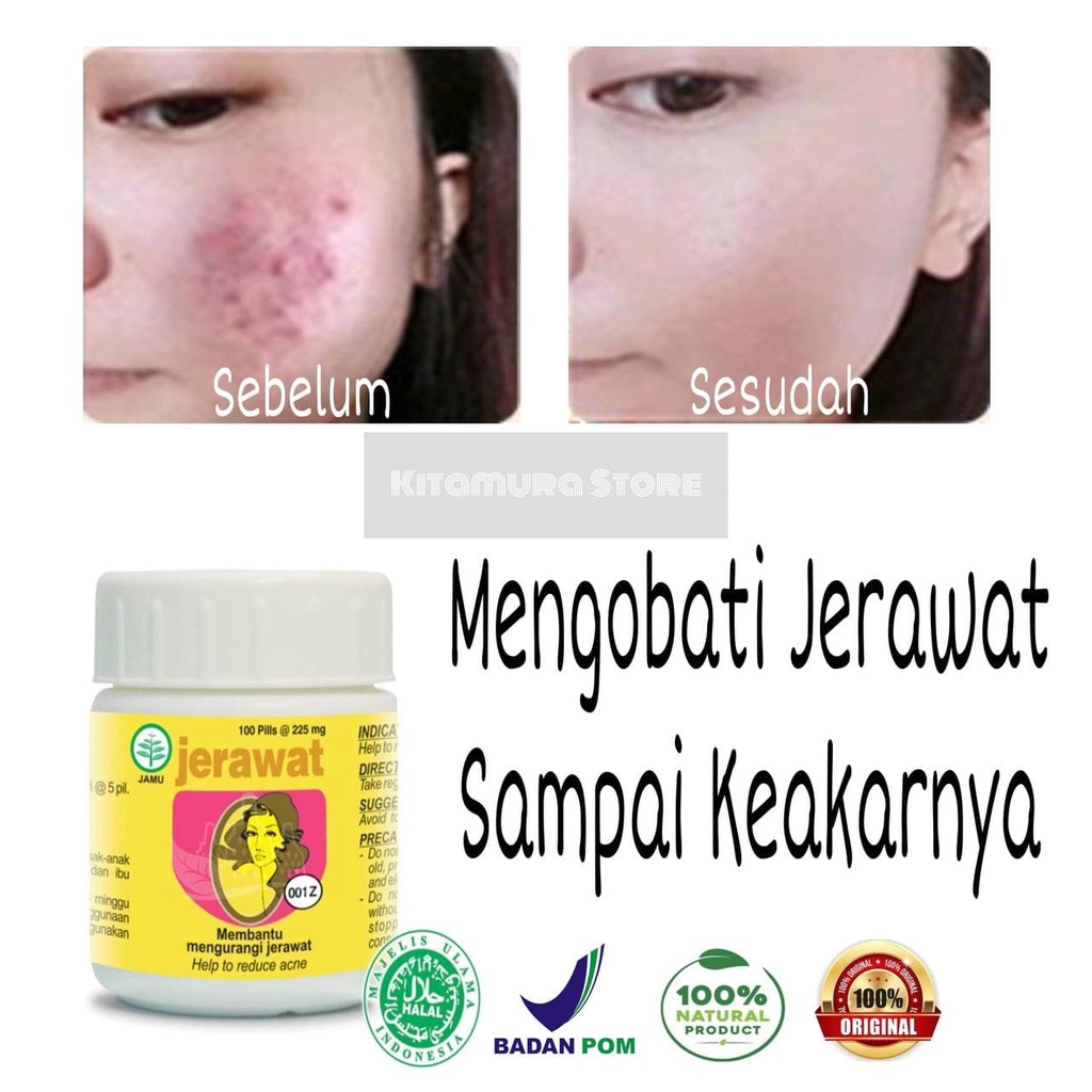 Herbal Perawatan Jerawat 100 Pil Obat Jerawat Ampuh Jerawat Batu Alami untuk Pria Wanita