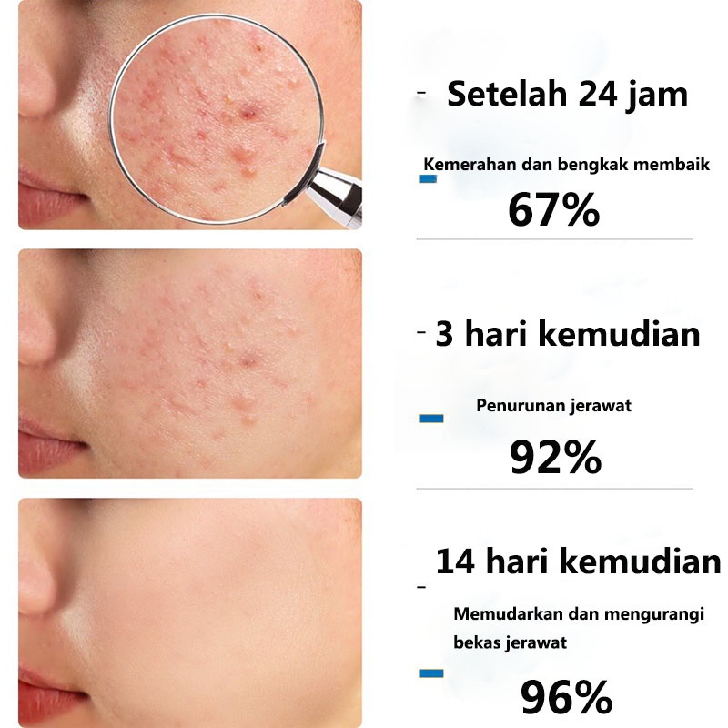 acnecare Krim Wajah Berjerawat obatjerawat 50g herbal ekstrak krim jerawat  halal  menghilangkan bekas jerawat  bekas jerawat  memutihkan kulit