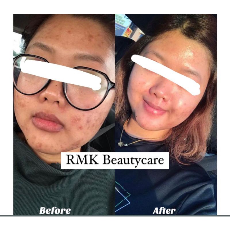 paket acne whitening cream jerawat radang jerawat bruntusan RMK