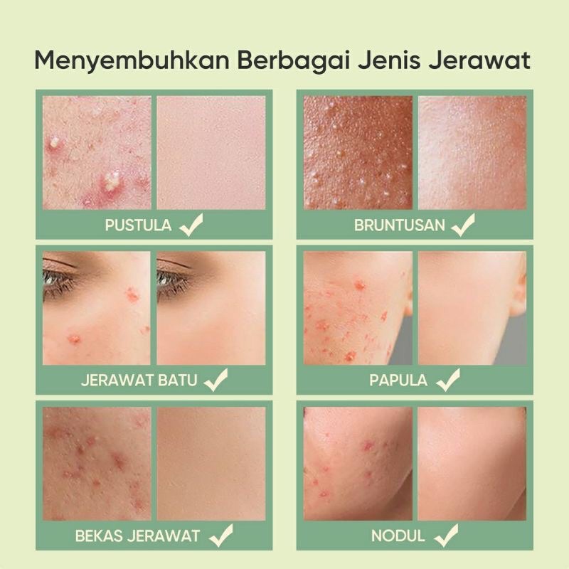 (BISA COD) SKINTIFIC SALICYLIC ACID BHA ACNE SPOT TREATMENT