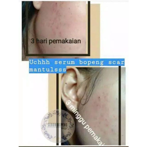 Serum Bopeng Manja Original