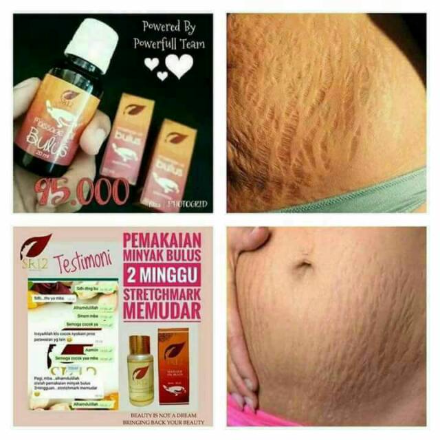 Super Minyak Bulus Sr12 Asli Bpom Solusi Jerawat Flek Hitam Dan Stretchmark Pembesar Payudara Shopee Indonesia