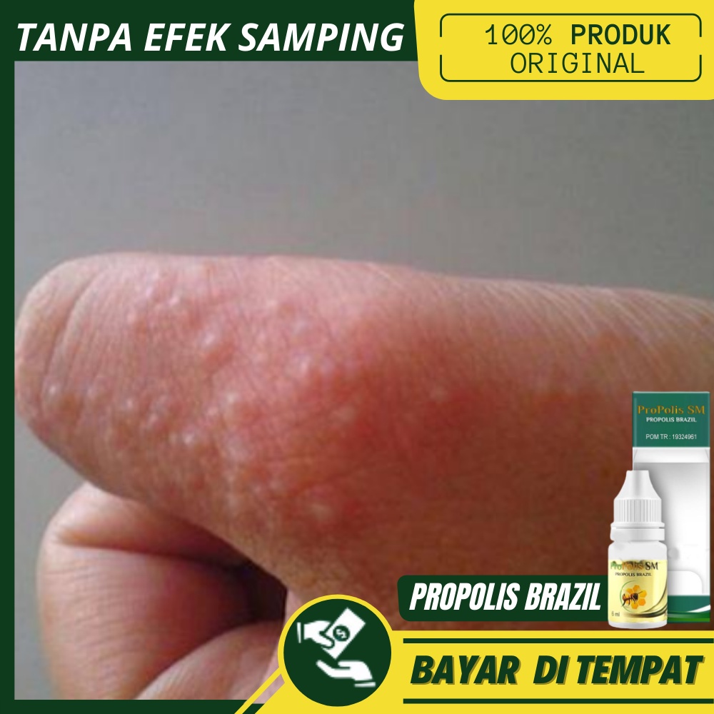 Obat Gatal Kulit Jari Tangan Dan Kaki Obat Menghilangkan Bintik Bening Berair Dengan Propolis Sm Shopee Indonesia