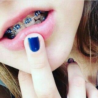 Behel Lepas Pasang / Behel Orthodontic / Behel Fashion / Behel Anti Karat / Behel Gigi