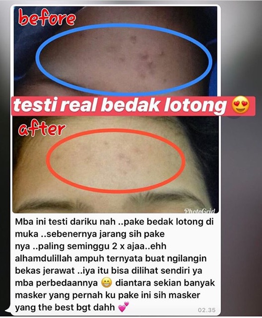 Bedda Lotong Bedak Lotong Bedak Hitam Masker Lulur Pemutih Alamai Shopee Indonesia