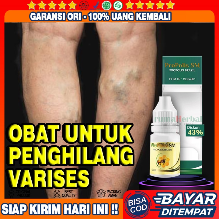 Obat Varises, Varises Varikokel, Buah Zakar Bengak, Urat Bercabang Di Kaki Lutut Betis