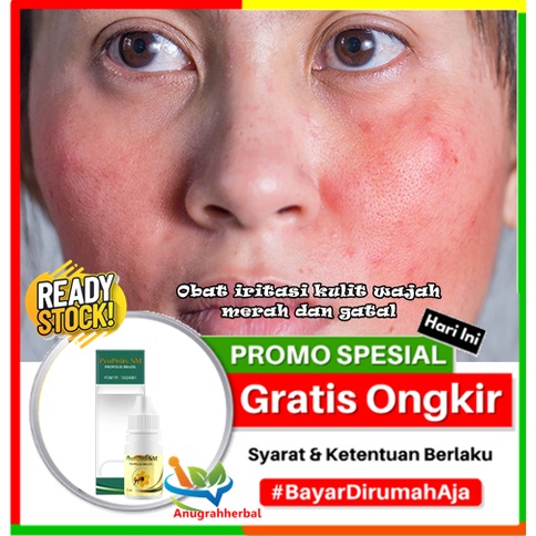 Obat iritasi kulit wajah merah dan gatal, mengatasi wajah iritasi merah dan gatal, muka iritasi mera