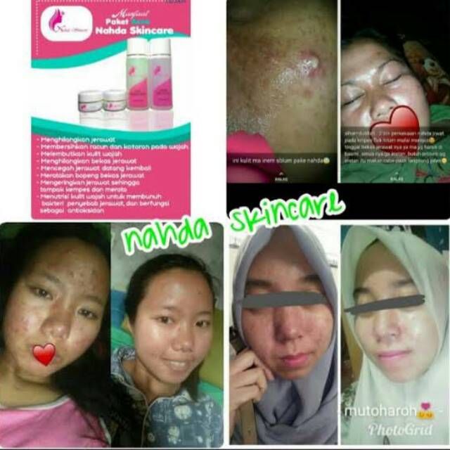 NAHDA SKINCARE ACNE