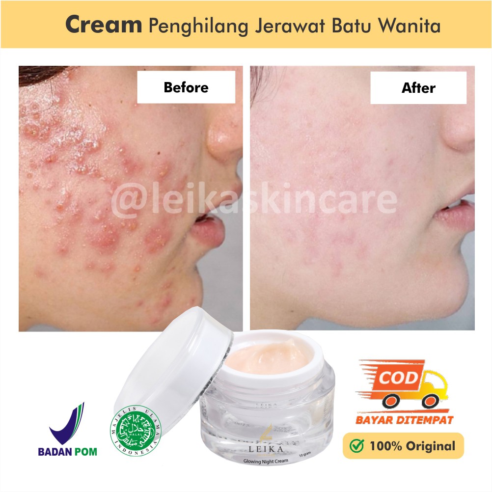 Night Cream Acne Penghilang Jerawat Batu Cream Malam Acne Penghilang Jerawat Batu Dan Bekas Jerawat 