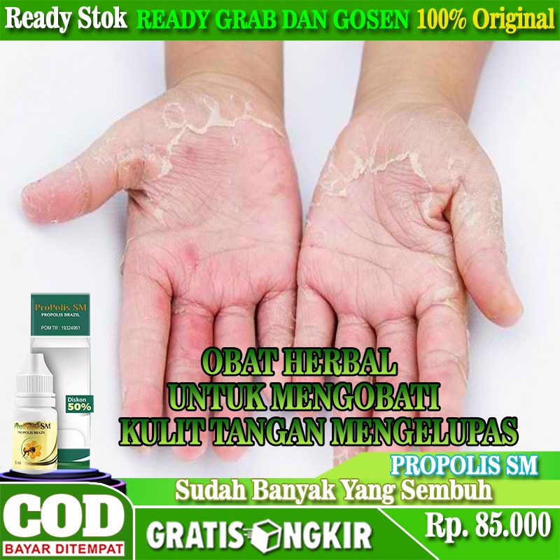 Obat Kulit Telapak Tangan Mengelupas, Obat Oles Atasi Kulit Mengelupas, Obat Alami Untuk Kulit Telap