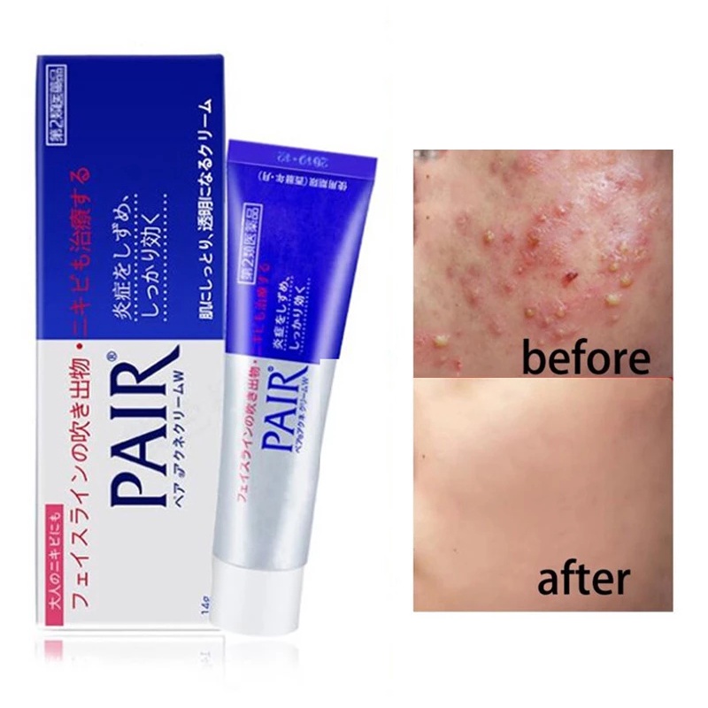 LION PAIR Acne Cream W24g  Antibacterial Acne Face Krim W Anti Jerawat Original Jepang