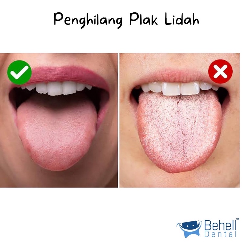 BEHELLDENTAL - TONGUE CLEANER ORIGINAL DR.SMITH - Pembersih Sikat Cleaning Clean Cleaner Lidah Asli Dr Smith - Sikat Brush Lidah - Bagus Untuk Pengguna Ortho Dental Behel - Penghilang kotoran Mirip qoral