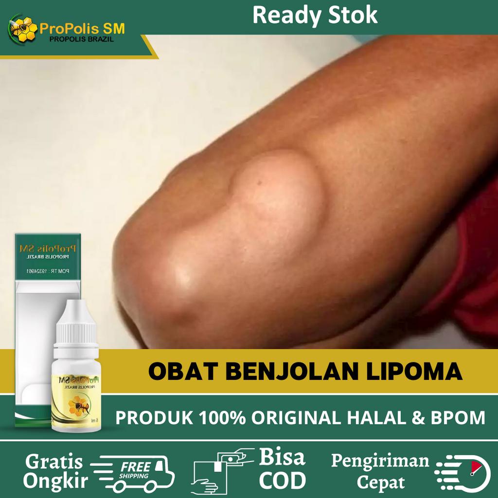 Obat Lipoma Herbal, Obat Oles Penghancur Benjolan Lipoma, Obat Tetes Oles Lipoma Terlaris, Obat Peng