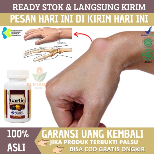 Obat Benjolan Di Tangan, Obat Kista Ganglion, Obat Benjolan Lipoma, Obat Benjolan, Obat Benjolan Per