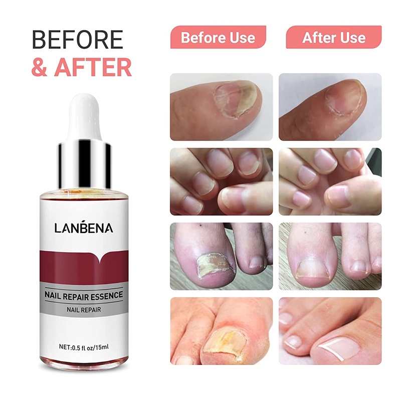 LANBENA LB-26 Nail Repair Perawatan Esensi Serum Jamur Kuku Essence Oil Serum Nail Treatment