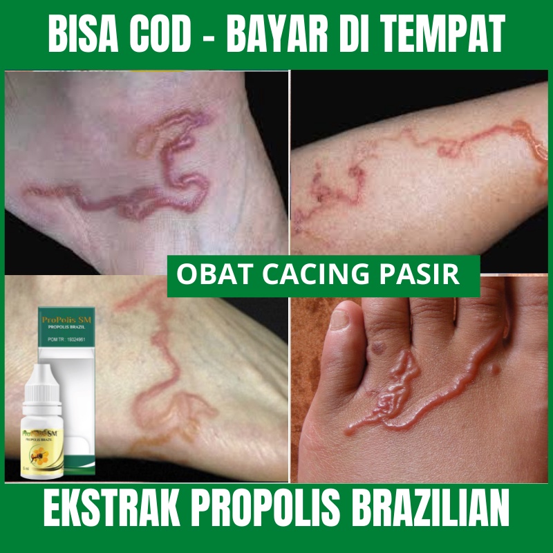 Jual Obat Cacing Pasir Menghilangkan Cacing Pasir Di Kulit Larva