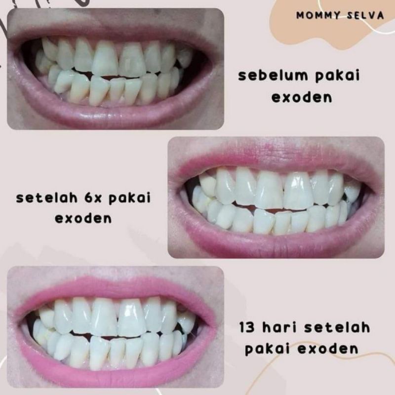 EXODEN MCI Whitening Gigi &amp;Gusi/Pasta Bubuk Terbaik made Korea