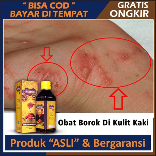 Obat Borok Di Kulit Kaki, Borok Bernanah Di Apotik, Borok Biar Cepat kering, Borok Parah, Borok Diab