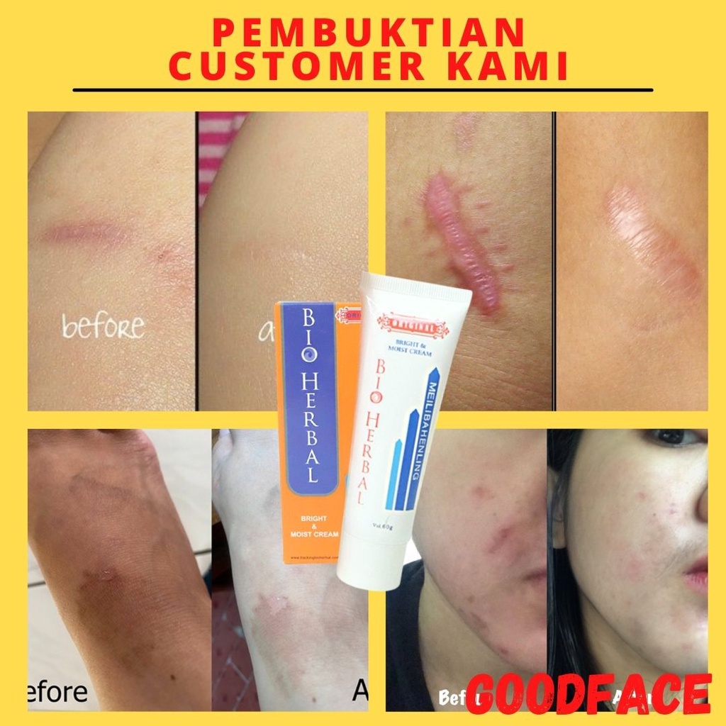 PENGHILANG BEKAS LUKA BAKAR MEILIBAHENLING CREAM LUKA ORIGINAL BPOM OBAT BEKAS LUKA SALEP BEKAS LUKA