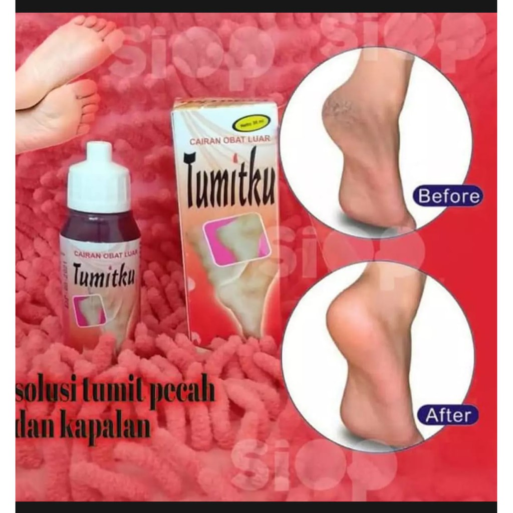 Tumitku Obat Kaki Pecah Kapalan Penghalus Tumit Kaki Obat Kapalan Obat Kaki Pecah Obat Kutu Air