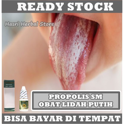 Obat Lidah Putih - Obat Lidah Berjamur, Lidah Pecah, Radang Lidah, Mulut Terasa Pahit, Sariawan Lidah, Lidah Pahit, Lidah Mati Rasa, Lidah Putih, Lidah Melepuh, Parasit Bau Mulut, Mulut Bau Busuk, Halitosis Dengan Propolis SM