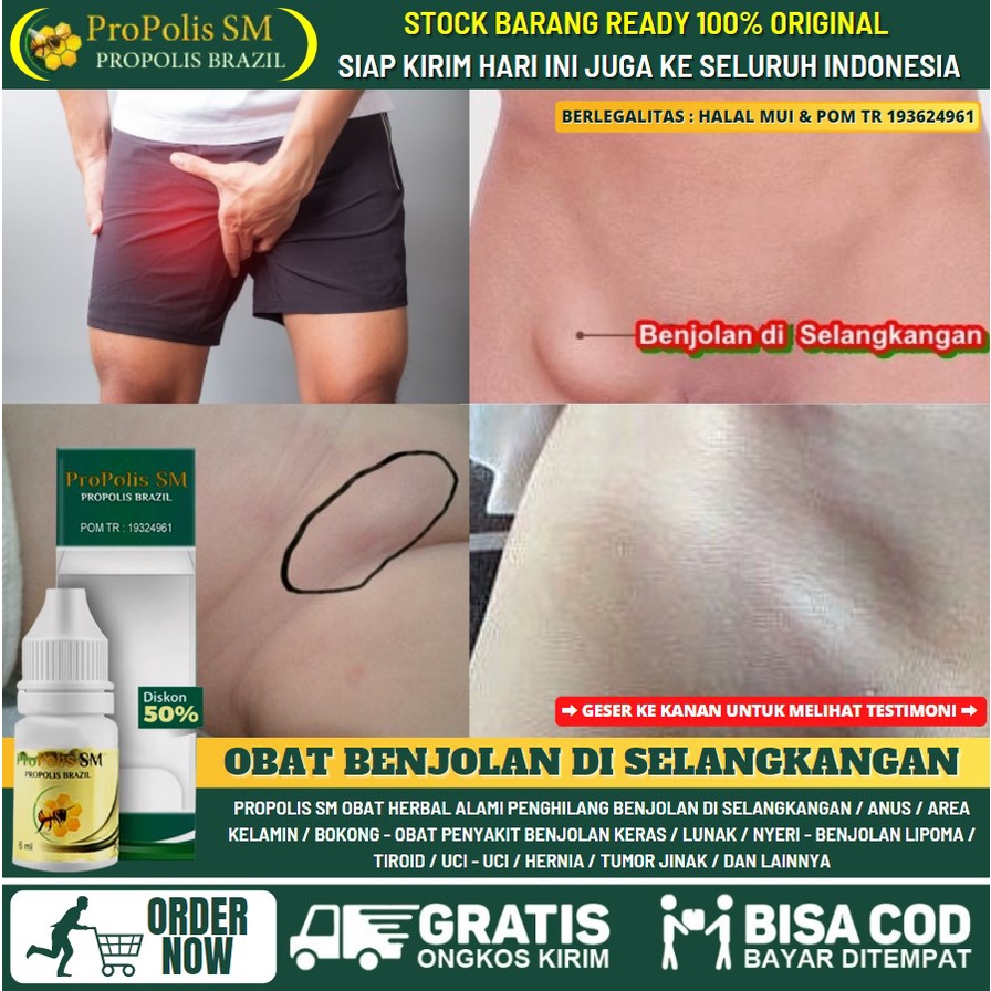 Obat Benjolan Lipoma di Selangkangan 100% Herbal - Obat Penghilang Benjolan Abnormal di Selangkangan