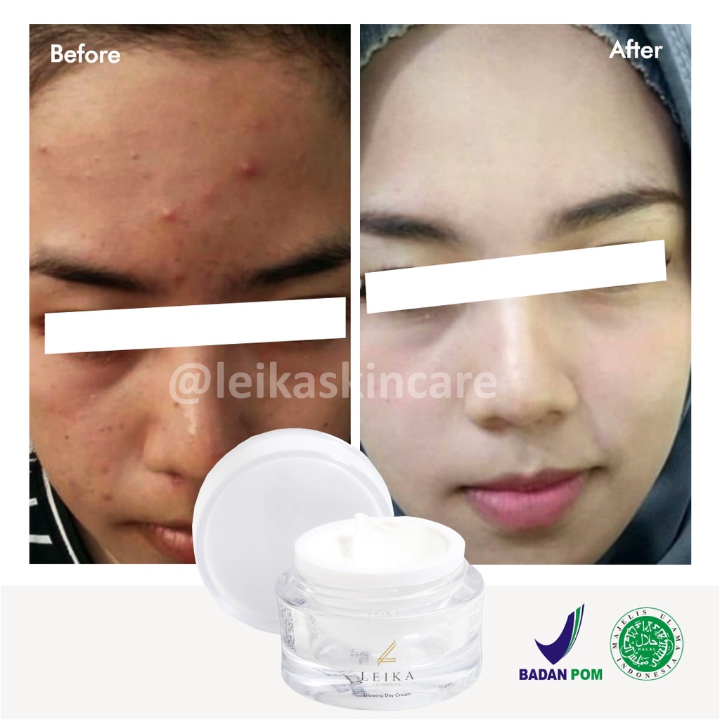 Obat Jerawat Paling Cepat dan Ampuh BPOM Obat untuk Kulit Wajah Berminyak Berjerawat Asli 100% dan Halal MUI Glowing Day Cream Leika Skincare 10gr Penghilang Jerawat Ampuh Aman Ori