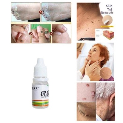 Obat penghilang Kutil Mata Ikan Tahi Lalat Skintag Remover Original