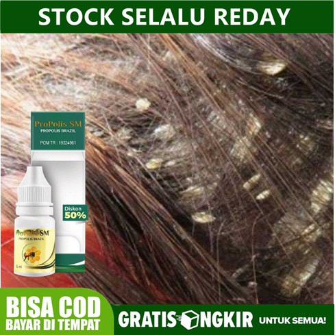 Obat Gatal Ketombe Di Kepala , Ketombe Kering , Ketombe Basah Obat Ketombe Di Kepala l Propolis sm